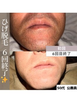 アカラビューティー(Akala Beauty)/ひげ脱毛〈６回終了！〉