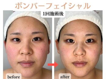 コトハ(cottha)の写真/ほうれい線/たるみ/口の横のポニョ/フェイスラインのカーブ/たるみ毛穴/デコルテ美人にもなれる最強コース