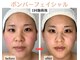 コトハ(cottha)の写真/ほうれい線/たるみ/口の横のポニョ/フェイスラインのカーブ/たるみ毛穴/デコルテ美人にもなれる最強コース