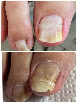 ココ ネイル サロン アンドスクール(COCO.NAIL SALON&SCHOOL)/巻爪