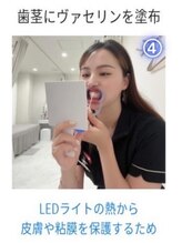 ホワイトニングショップ 三島店(WHITENING SHOP)/【ホワイトニングの流れ】４