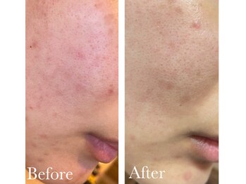 MMK/赤みバイバイ自信がもてる素肌へ