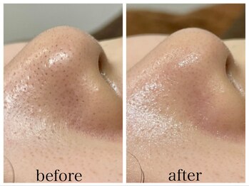 アリエス/ハイドラ×顔脱毛1回の変化