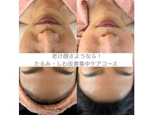 ギャラント(GALLANT)の雰囲気（もう同窓会も怖くない！老けサインのほうれい線たるみしわも改善）
