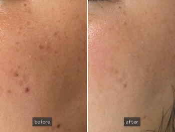 SEC(Shizuoka esthetic company)/【シミ改善】オプションケア