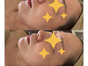 アイリーボーテ 東大阪(アイリーBEAUTE)/ラジオ波！