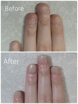 アウラ ネイル ファクトリー(aura nail factory)/深爪矯正スカルプ(長さだし)赤羽