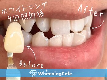 ホワイトニングカフェ 金沢店(WhiteningCafe)/◎歯のホワイトニング施術写真◎