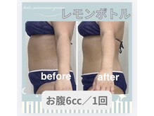 ハロ 南青山(HALO)/レモンボトルお腹6cc