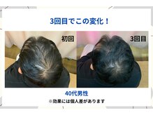 福山発毛センターの雰囲気（４０代の方の比較写真！施術３回でこんなに見た目も変わります）