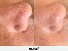 ナルムフェイシャル 代々木(NARUM facial)/毛穴洗浄