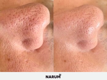 ナルムフェイシャル 代々木(NARUM facial)/毛穴洗浄