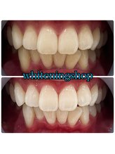 ホワイトニングショップ 大阪玉造店/Before&After美白ホワイトニング