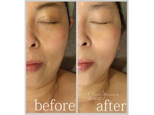 アン グレーヌ 自由が丘(unegraine)/頬のスッキリ感！明るい肌色