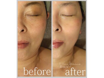 アン グレーヌ 自由が丘(unegraine)/頬のスッキリ感！明るい肌色