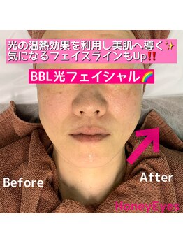 ハニーアイズ(Honey Eyes)/BBL光フェイシャル