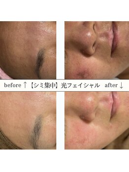 アースコアフュールボーテ 佐野新都市店(EARTH coiffure beaute)/【光フェイシャル】Before/After
