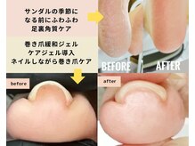 ワンアンドオンリー(one and only)の雰囲気（フットつるふわ角質ケア（上）　巻き爪ケアジェル導入（下））