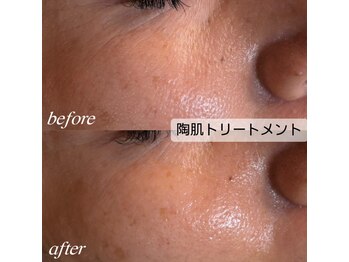 シュカ(Shuka)/ハーブピーリング