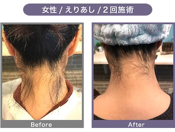 アンフィー 川西能勢口店(Une f`ee)/うなじ脱毛のBefore,After★