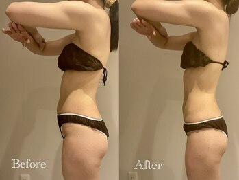 エステティック ミュー(Esthetic MiEUX)/ブライダル痩身