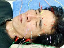 とだ鍼灸院/【顔の引き締め◎】美容鍼/電気