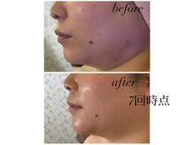 マスカレード(Masquerade)/レモンボトル