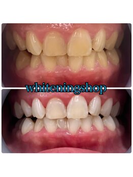 ホワイトニングショップ 武蔵小杉店/武蔵小杉ホワイトニング美白ケア