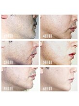 リノア(Linoa)/ヒゲ脱毛経過写真