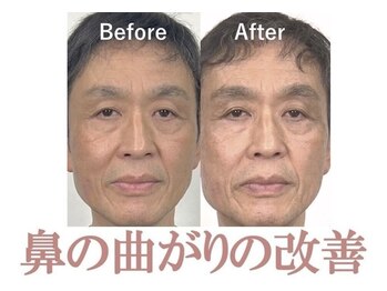 隆鼻矯正専門店 ラプリ(Raplit)/隆鼻＋輪郭矯正40分10回