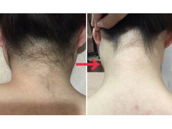 エステティックサロン サクラ(SAKURA)/スッキリうなじ美人！すぐに叶う