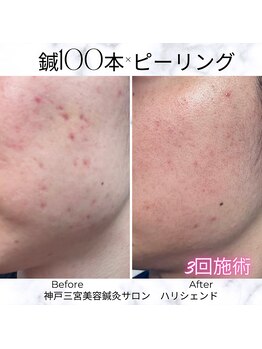 ハリシェンド/鍼100本×ピーリング