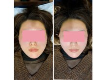 イズム まつもと店(izm)/小顔モニター様　むくみ解消