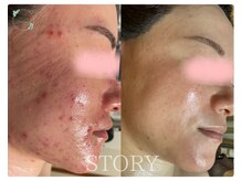 ストーリー(STORY)/ハーブピーリング専門店STORY