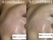 ディアーム 光明池店(Diarm)/陶肌ピール3回の変化☆