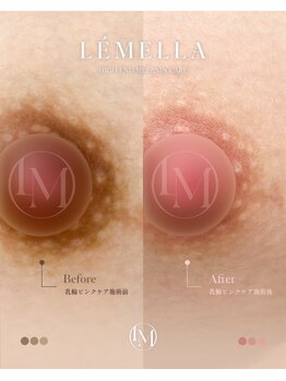 ルアナ(LUANA。)/#ルメラ#色素ケア#脱毛#三郷