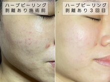 ココ 2号店(CoCo)/ハーブピーリング/改善事例