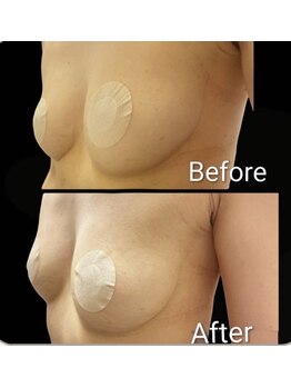 トータルビューティー筋膜ケアサロン カンスタイル(Kanstyle)/バストup