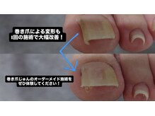 巻き爪じゅん 船橋店/巻き爪による変形1回で大幅改善