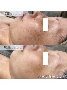 ネイルズビー 別邸(Nail's be)/どちらもbeforeでここまで差が！