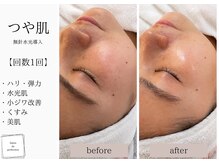 サロン ド パーフェクション(Salon de Perfection)/無針水光導入