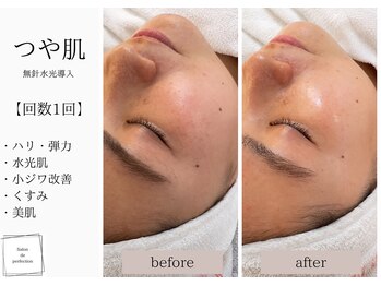 サロン ド パーフェクション(Salon de Perfection)/無針水光導入