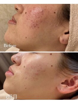 ルーヴェ(Luve)/陶肌トリートメント