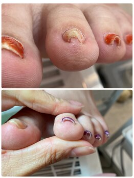 ココ ネイル サロン アンドスクール(COCO.NAIL SALON&SCHOOL)/巻爪