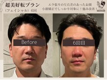 ラブミー 渋谷本店(LoveMe)/小顔・たるみ・ほうれい線・毛穴