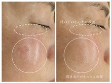 ラミーユ(La Miu)/エレサス(palupalu)エステコース