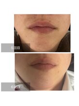 ダンニヒル(dannihil)/【ヒゲ脱毛】30代会社員6回目