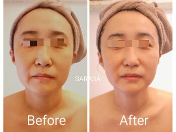 サラサ(SARASA)/くすみとたるみケア
