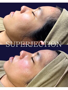 エスポワールカルド(Espoir caldo)の写真/ハリツヤUP！韓国VIP施術×高周波×SUPERJECTUONで輝く肌へ♪ナノチップ導入◎40文字