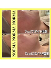 ノーマ(NORMA)/最新！レモンボトル×ダーマ